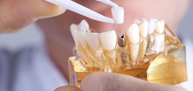 Facts You May Not Know About Dental Implants