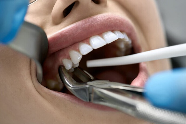 What Should You know About Tooth Extraction?