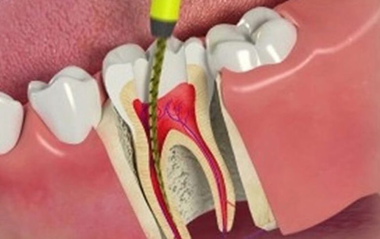 The cost of root canal treatment, you need to know