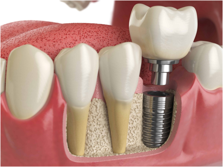 Dental Implant & Dentures, Which One Is the Most Appropriate Option?