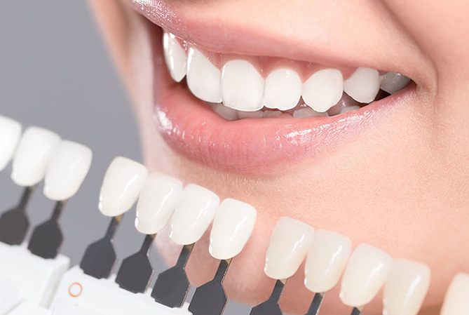 Porcelain Veneers