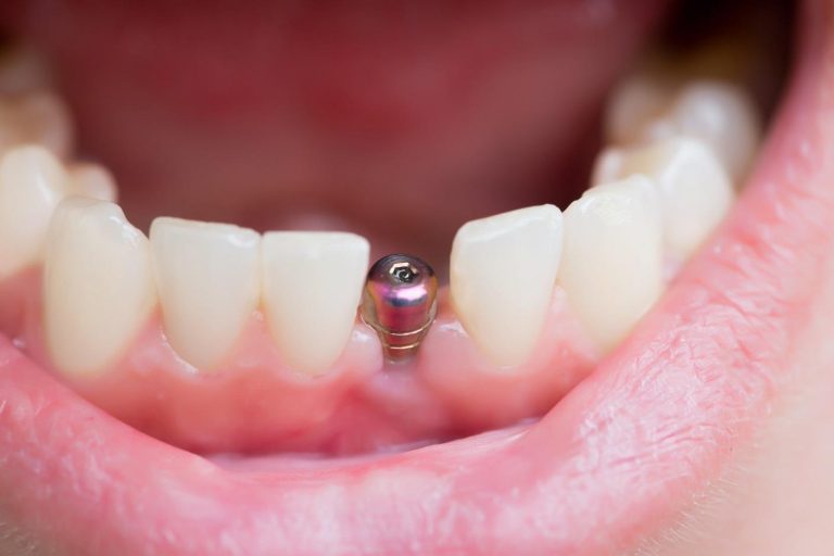 Dental Implants VS. Dental Bridges, Which Is a Better Tooth Replacement Option?