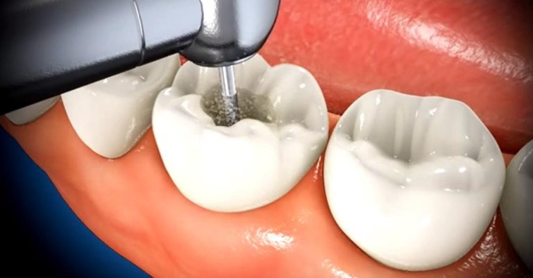 When Does a Tooth Need Root Canal Therapy?